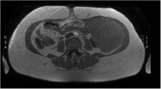 Preoperative MRI—saggital plane. T1 weighted image.