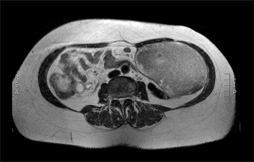 Preoperative MRI. T2 weighted image. Low sign density of the lesion.