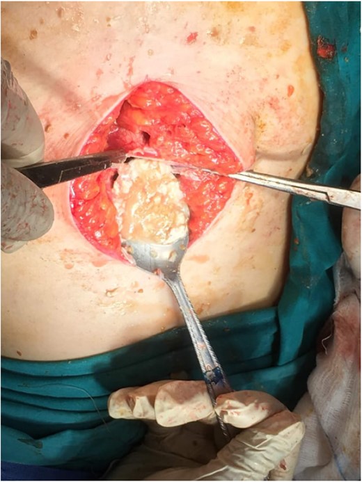 Intra-operative finding. Cyst content, indicating a hydatid cyst.