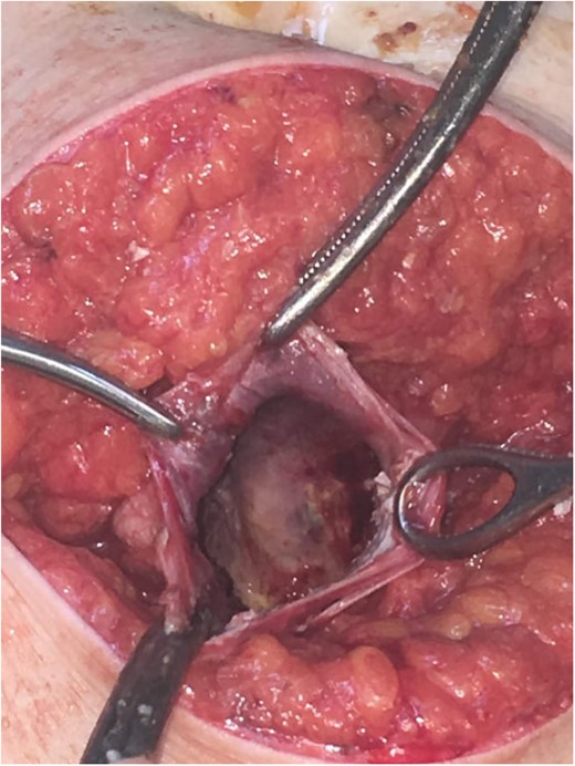 Total cyst drainage without spillage. Subsequent Pezzer tube placement through incision site.