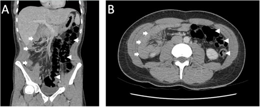 CT abdomen/pelvis in the portal venous phase (A) coronal, (B) axial demonstrating features of intestinal malrotation with the colon (arrowhead) predominantly located on the left and the small bowel (arrow) on the right.