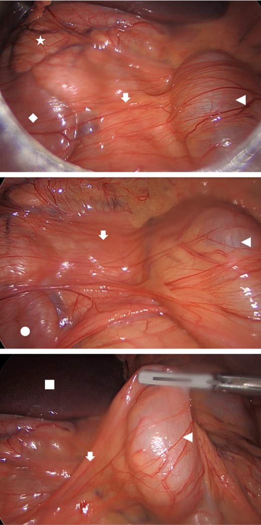 Intra-operative findings demonstrating Ladd’s bands (arrow) attached to the caecum (arrowhead) and spanning across the head of pancreas (star), second (diamond) and third (circle) part of the duodenum; left lobe of the liver (square) in the background.