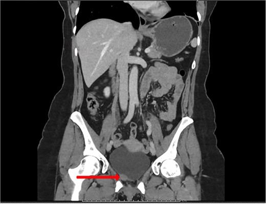 CT urogram (coronal view) revealing a 1.5 cm thickening at the level of the right lateral bladder neck and a 1-cm-soft tissue thickening at the bladder dome.