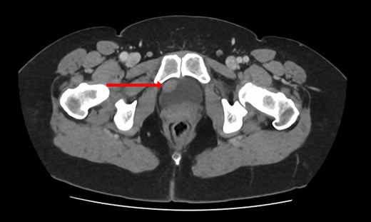 CT urogram (axial view) revealing a 1.5 cm thickening at the level of the right lateral bladder neck, and a 1-cm-soft tissue thickening at the bladder dome.