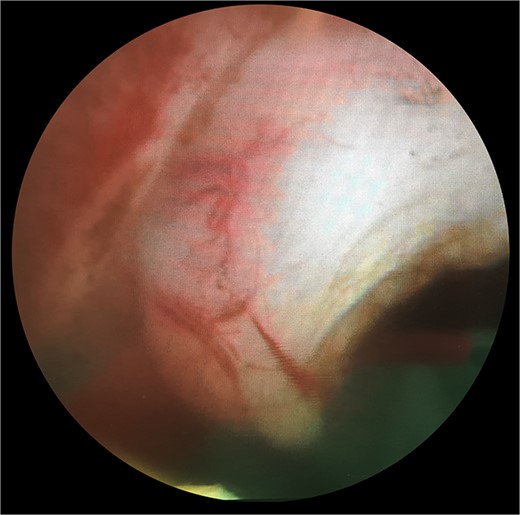 Endoscopic appearances during transurethral resection of the lesion. Note the presence of normal overlying mucosa and the thickened solid-looking non-papillary appearance.
