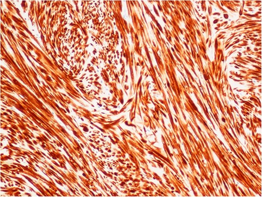 Immunohistochemical staining for desmin, demonstrating the fascicular architecture of bladder leiomyoma (×10 objective).