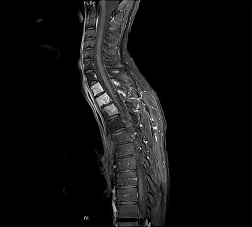 Preoperative sagittal MRI (STIR) image of patient No. 2 depicting active tumor invasion of T1, T2 and T3 as well as pathological hypodense C7 and Th4 vertebral bodies.
