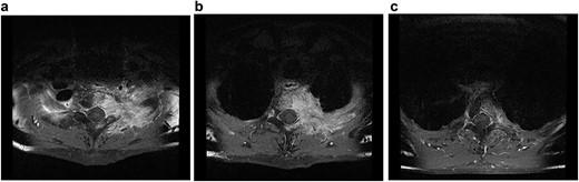 Transversal MRI STIR-images of patient No. 2 with Th1 (a), Th2 (b) and Th3 (c).