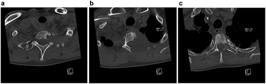 Transversal CT scans of the thoracic. Extent of bony destruction of the left pedicle, costotransverse joint and facet joint of C7/Th1 (a), the left hemilamina, pedicle, costotransverse facet joints, rib and vertebral body of Th2 (b) and hemilamina as well as pedicle of Th3 (c).