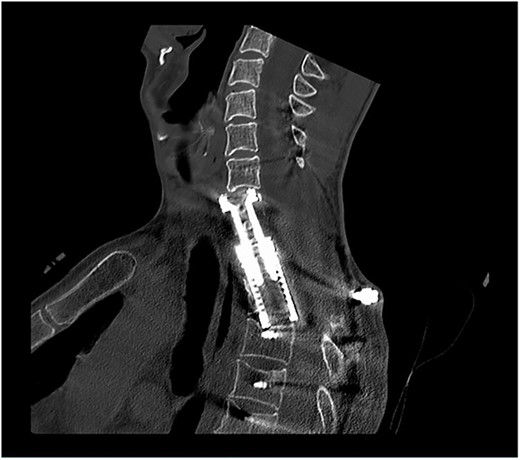 Postoperative sagittal CT scans with 3D-reconstruction after 360° fusion. The vertebral body replacement with a distractable cage, which is displaced anteriorly because of a slight endplate sintering.