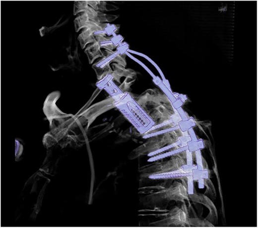 Postoperative sagittal CT scans with 3D-reconstruction after 360° fusion. The vertebral body replacement with a distractable cage, which is displaced anteriorly because of a slight endplate sintering.