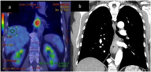 Case 1. CT and FDG-PET imaging of primary oesophageal tumour. Thickening of the oesophageal wall (a) and intense uptake on FDG-PET (b).