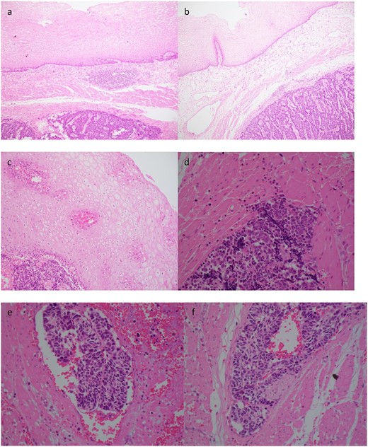 Case 2. Histopathology of the primary tumour. (a) and (b) demonstrates intact overlying oesophageal squamous mucosa, undermined by the infiltrative small cell lesion with invasion of the lamina propria (c), muscularis propria (d), vessels (e) and nerves (f).