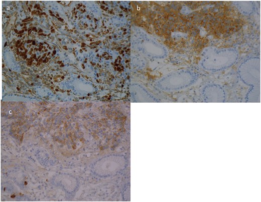 Case 4. Immunohistochemical profile of the tumour demonstrating a classical profile for neuroendocrine carcinoma. (a) Ki67, (b) synatophysin, (c) CgA.