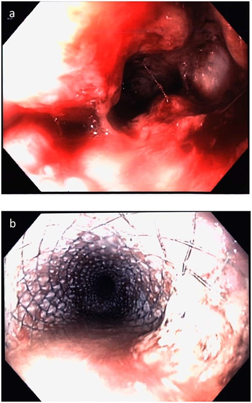 Case 5. Endoscopy demonstrating (a) ulcerated stenosing tumour at the distal oesophagus and (b) oesophageal stent in situ.