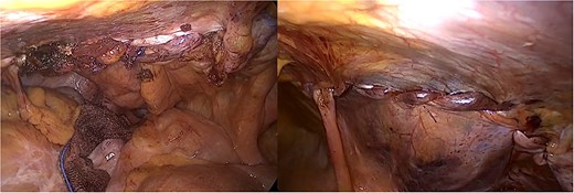Laparoscopic images after laparoscopic hernia repair.