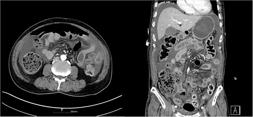 Abdomen CT showed complicated fluid collection and free air in the abdominal cavity.