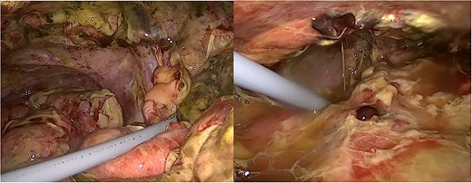 Laparoscopic images of bowel perforation and severe intra-abdominal contamination.