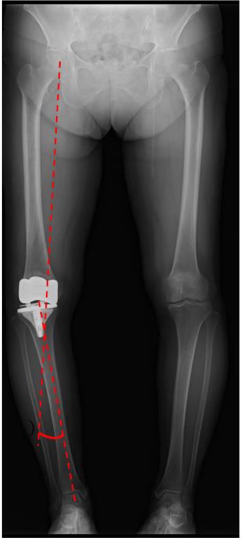 Post-operative standing plain radiograph. The hip-knee-ankle angle was 14° varus.