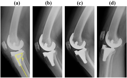 Post-operative anteroposterior and lateral plain radiographs. The γ angle was 82°. (a) Immediate after surgery, (b) 5 years after surgery, (c) 8 years after surgery, (d) 10 years after surgery.