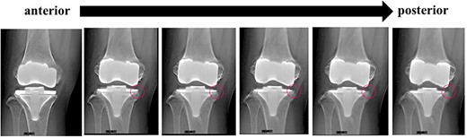 Cross-sectional anteroposterior imaging using Tomosynthesis-Shimadzu metal artifact reduction technology (T-smart) (Japan) showed tibial component subsidence at the medial tibial plateau (red circles).