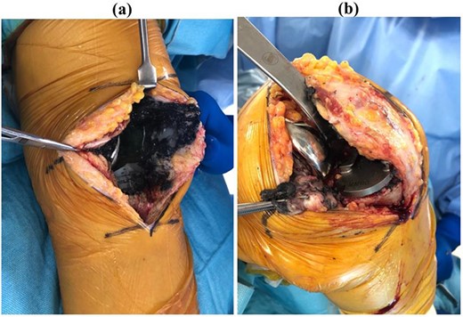 Intraoperative photograph in (a) extension and (b) flexion. Black deposits associated with metallosis were observed throughout the intra-articular joint.