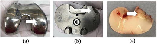 Images of the removed prosthesis. (a) Wear of the medial part of the femoral component (white arrow). (b) Breakage of the posteromedial part of the tibial component (white arrow). (c) UHMWPE wear (white arrow).
