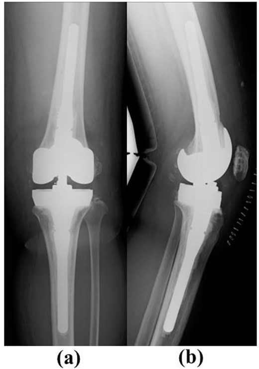 Post-operative plain radiographs after revision total knee arthroplasty. (a) Anteroposterior view and (b) lateral view. The NexGen LCCK (Zimmer Biomet, Warsaw, IN, USA) with stem extension on both the femoral and tibial sides was chosen. Full block augmentation (10 mm) was used on the tibial side.