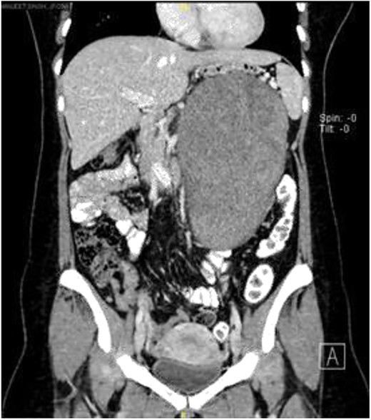 Coronal view of computerized tomography abdomen