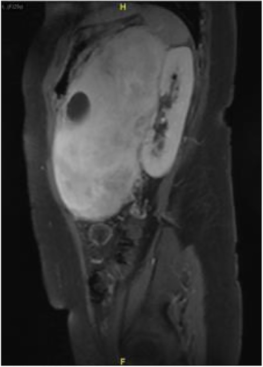 Sagittal view on magnetic resonance imaging abdomen