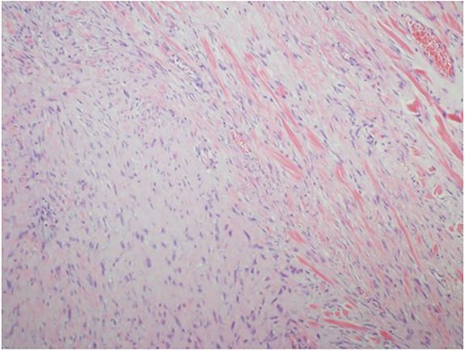 Histopathological findings. Spindle cells fascicles with collagen formation (H&E ×100).
