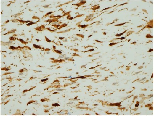 Histopathological findings. The tumour cells are positive for beta-catenin (H&E ×400).