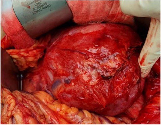 Intra-operatively, the tumour was stretching the mesocolon, and laterally adherent to the left kidney