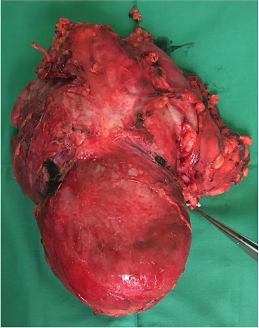 Tumour removed. Pointer demonstrates the left ureter.