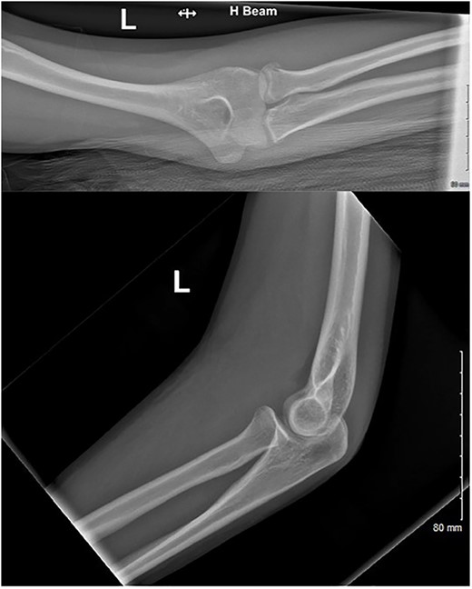 AP and lateral radiographs of the injury at first presentation to the emergency department.
