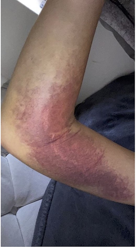 Haematoma evident at day-1 post-injury.