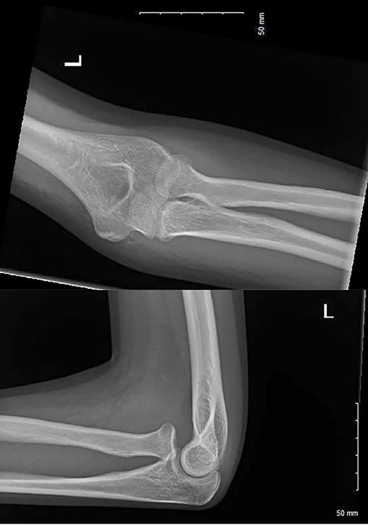 AP and lateral radiographs at 2 months post-injury.