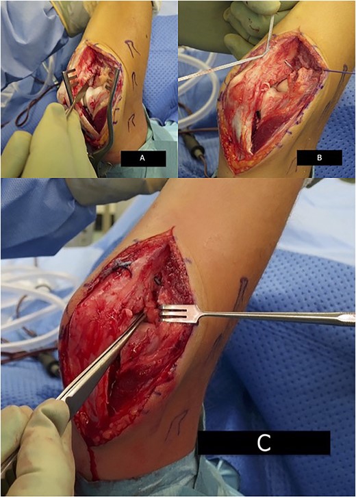 Intra-operative image demonstrating annular ligament reconstruction. (A) Surgical view via Boyd approach demonstrating ruptured annular ligament and LUCL. (B) No.2 Fibertape suture reconstruction. (C) Forceps demonstrate reconstructed LUCL and annular ligament.