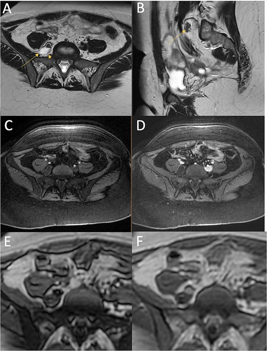 T2 (A, axial; B, sagittal) and T1-weighted with fat saturation (C, axial pre-contrast; D, axial post-contrast), T1 dixon (E, axial in-phase; F, axial out-of-phase) images from the MRI of the pelvis at presentation. The heterogeneous complex cystic mass (arrow) is located lateral to the vertebral body and posterior and medial to the psoas muscle. It is characterised by predominantly high T2 signal, with a region of dark T2 signal anteriorly, low T1 signal on fat-saturated images. The anterior T2 dark component shows drop out on the out-of-phase imaging compared with the in-phase imaging indicating a component of fat. It abuts the right L5 nerve root (arrowhead).