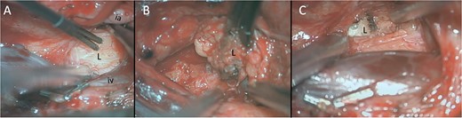 Intra-operative pictures. Direct electrical stimulation of lesion (L) when first reached (A) located between and posterior to the iliac artery (ia) and iliac vein (iv). Lesion contained both fatty (B) and pearly appearing flakes (C).