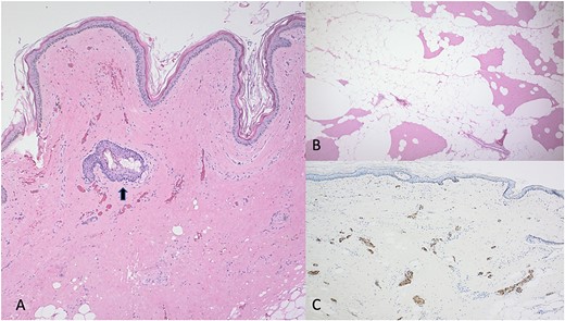(A) Dermoid cyst (H&E; 40×). The cystic structure is lined by squamous epithelium. In the surrounding dense fibrosis, there is a hair follicle and an associated sebaceous gland (arrow). (B) Surrounding the cystic lesion these is adipose tissue, reminiscent of an intramuscular lipoma (H&E; 40×). (C) Within the dense fibrous soft tissue of the cyst, there are numerous small nerve twigs (S100 protein; 40×).