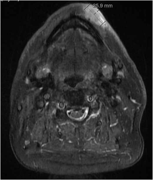 Axial STIR MRI image of lesion at level of chin.