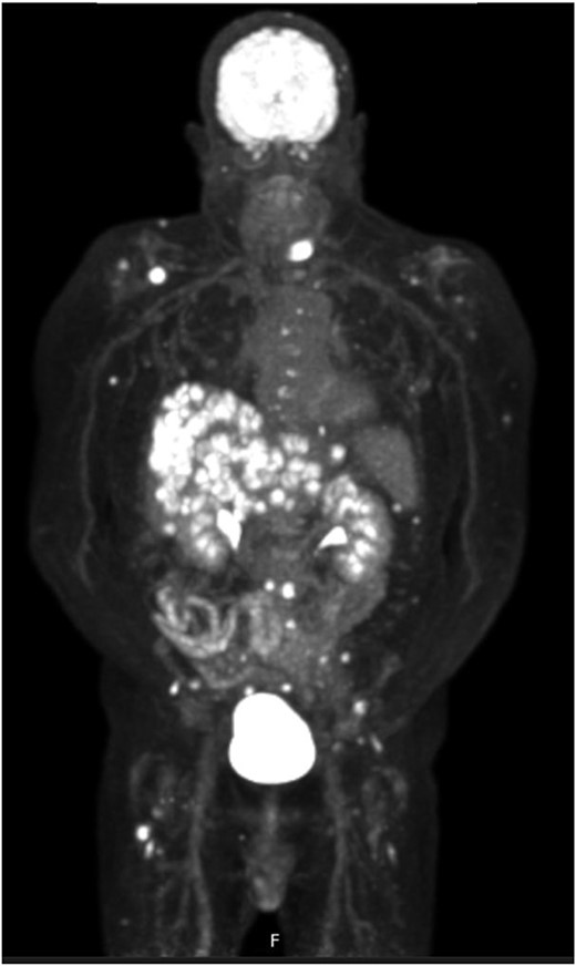 FDG PET CT imaging showing locations of metastases.