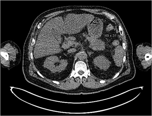 Axial CT imaging showing malignant primary at pancreatic tail.
