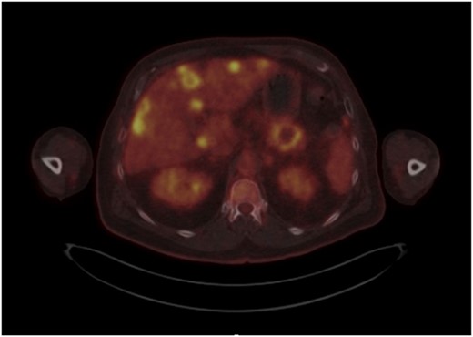 Axial FDG PET CT showing liver metasteses.