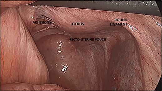 Posterior view of the uterus during laparoscopy.