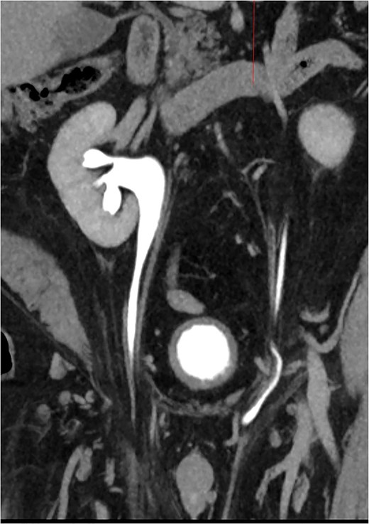 CT Urogram with bilateral ureteroinguinal scrotal hernia. Maximum intensity projection image has been reformatted to highlight both ureters crossing the inguinal canals.