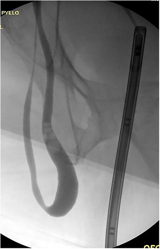 Retrograde pyelogram exhibiting ureter herniated into scrotum prior to hernia repair. Filling defects consistent with air bubbles.