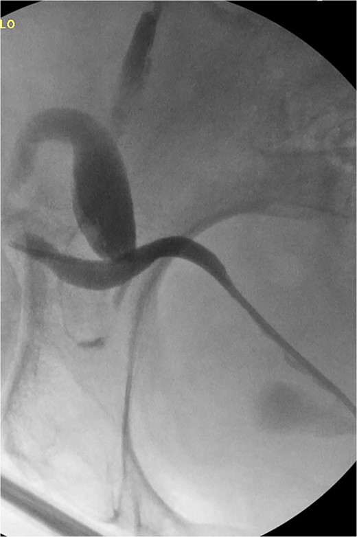 Retrograde pyelogram following hernia repair with tortuous path of the ureter.