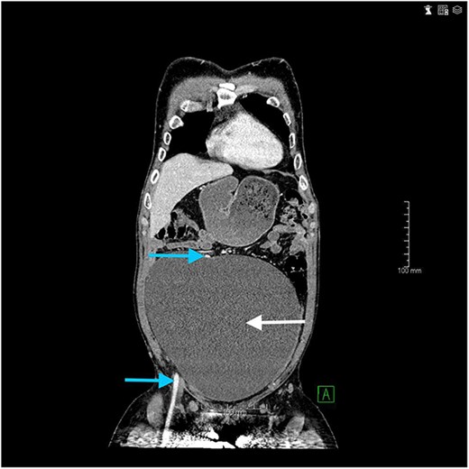 Coronal view from an abdominal CT showing the retroperitoneal cyst (arrow on the right side of the figure) and the course of the right external iliac vessels (arrows on the left side of the figure).